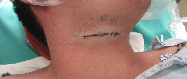 Cervical Lymph Node Excision Biopsy