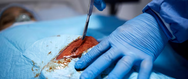 Endoscopic Cribriform Plate Reconstruction