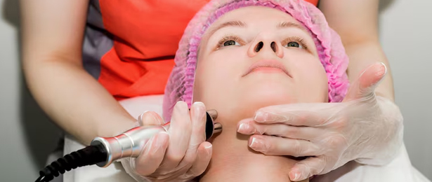 Fractional RF Microneedling