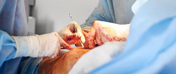 Gingivobuccal Sulcus Cancer Surgery
