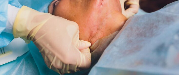 Selective Modified Radical Radical Neck Dissection