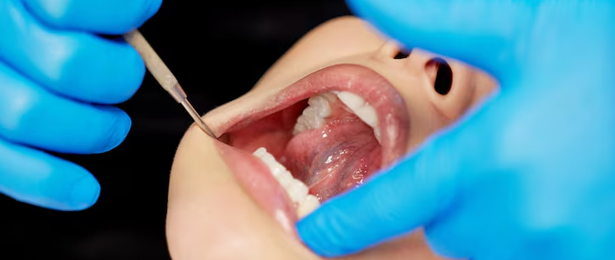 TORS Tonsil Cancer Surgery